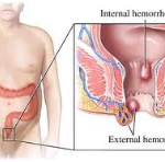 hemorrhoid treatment